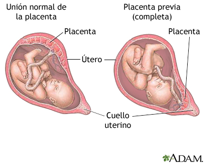 Placenta previa Placenta previa