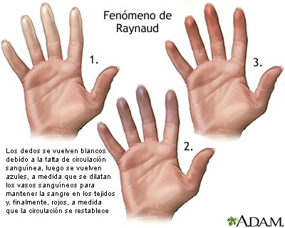 Fenómeno de Raynaud Fenómeno de Raynaud