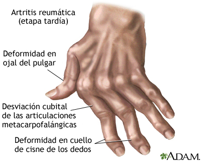 Artritis reumatoide Artritis reumatoide