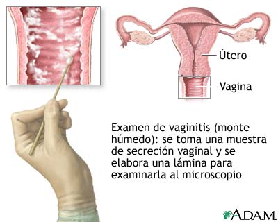 Prueba de vaginitis (montaje húmedo) Prueba de vaginitis (montaje húmedo)