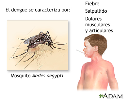 Fiebre por dengue Fiebre por dengue
