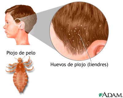 Piojos de la cabeza Piojos de la cabeza