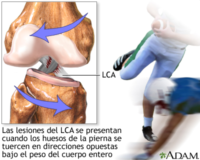 Lesión del LCA Lesión del LCA