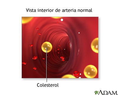 Bloqueo en la arteria carótida interna Bloqueo en la arteria carótida interna