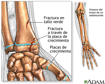 Fracturas a lo largo de una placa de crecimiento Fracturas a lo largo de una placa de crecimiento