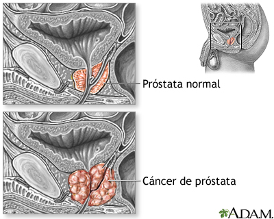 Câncer de próstata Câncer de próstata