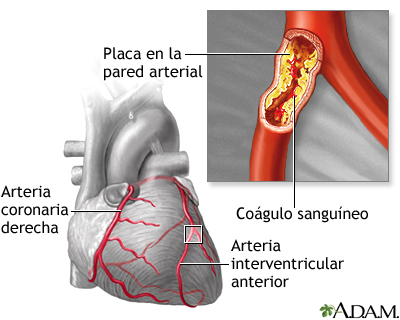 Aterosclerosis Aterosclerosis