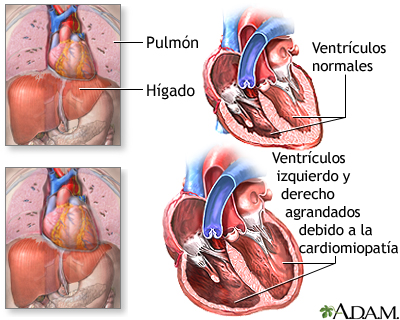 Cardiomiopatía alcohólica Cardiomiopatía alcohólica