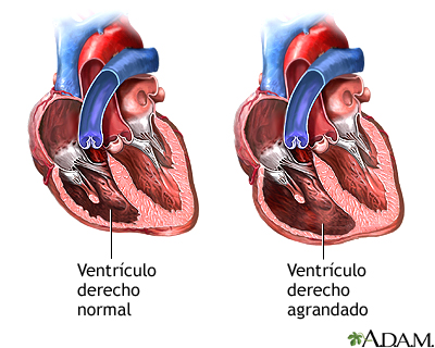 Regurgitación tricuspídea Regurgitación tricuspídea