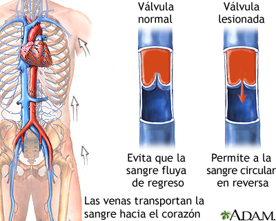 Insuficiencia venosa Insuficiencia venosa