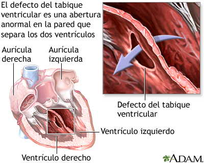 Defecto del tabique ventricular Defecto del tabique ventricular