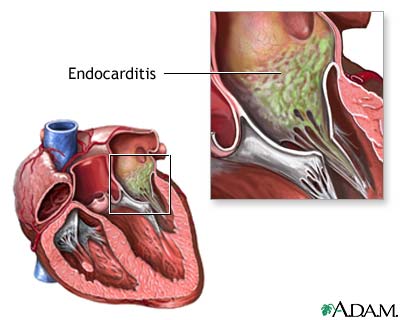 Endocarditis de cultivo negativo Endocarditis de cultivo negativo
