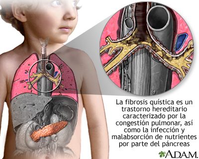 Fibrosis quística Fibrosis quística