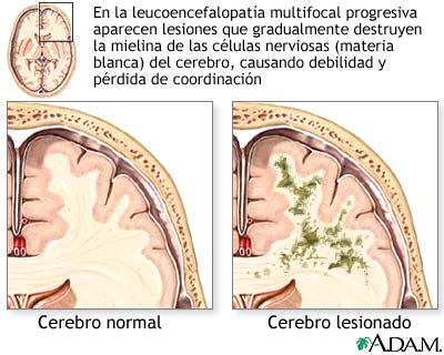 Leucoencefalopatía Leucoencefalopatía