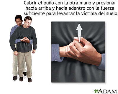 Maniobra de Heimlich en el adulto Maniobra de Heimlich en el adulto