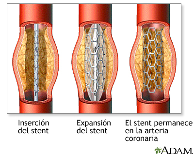 Procedimiento (cuarta parte) Procedimiento (cuarta parte)