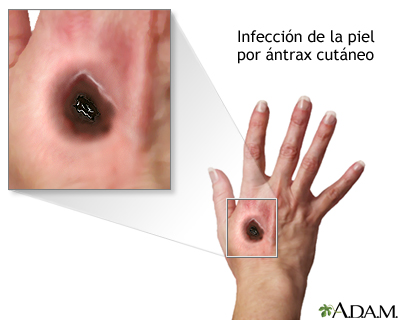 Ántrax cutáneo Ántrax cutáneo