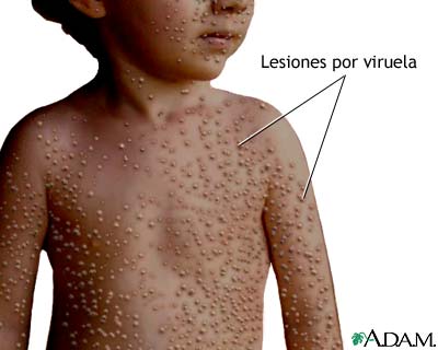 Lesiones por viruela Lesiones por viruela
