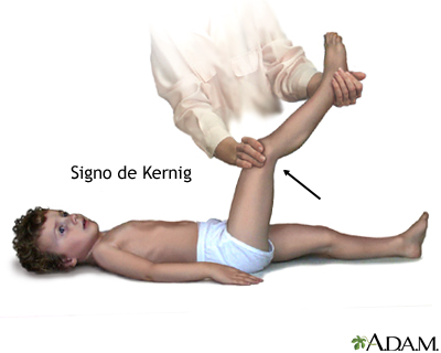 Signo de meningitis de Kernig Signo de meningitis de Kernig