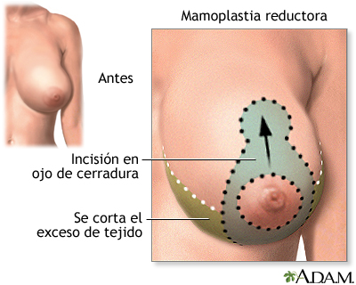 Incisión Incisión