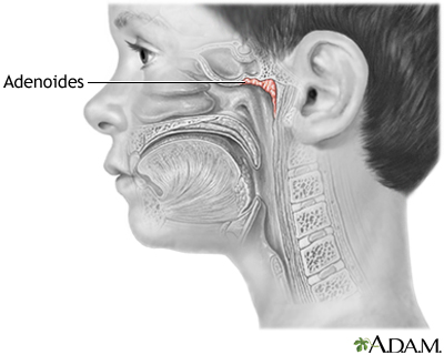 Adenoides Adenoides
