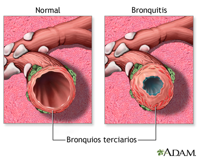 Bronquitis y condición normal de los bronquios terciarios Bronquitis y condición normal de los bronquios terciarios