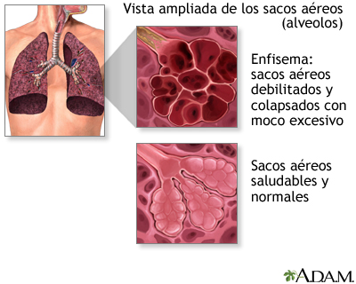 Enfermedad pulmonar obstructiva crónica (EPOC) Enfermedad pulmonar obstructiva crónica (EPOC)