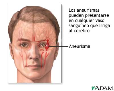 Aneurisma cerebral Aneurisma cerebral