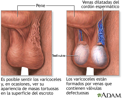 Varicocele Varicocele