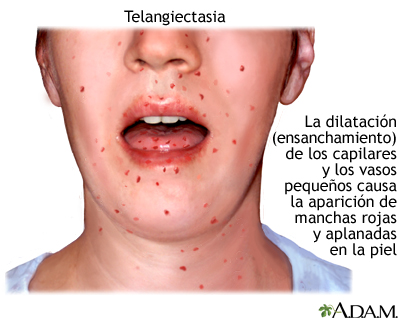 Telangiectasia Telangiectasia
