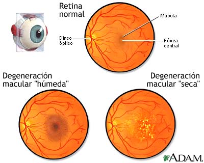 Degeneración macular Degeneración macular