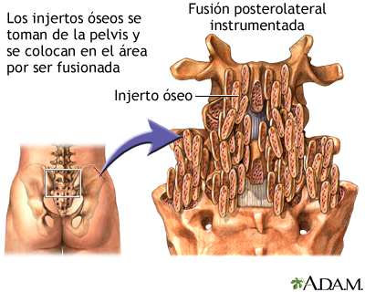 Procedimiento - Fusión posterolateral instrumentada Procedimiento - Fusión posterolateral instrumentada