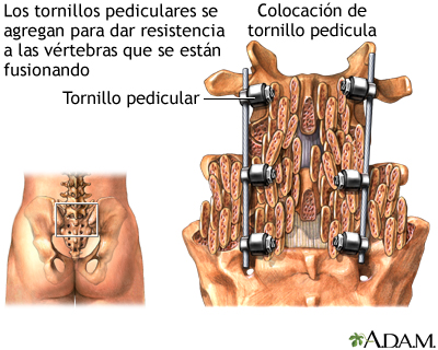 Tornillos pediculares Tornillos pediculares
