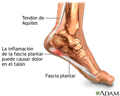 Fascitis plantar Fascitis plantar