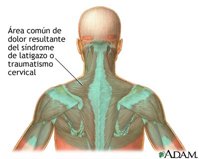 Localización del dolor por latigazo Localización del dolor por latigazo