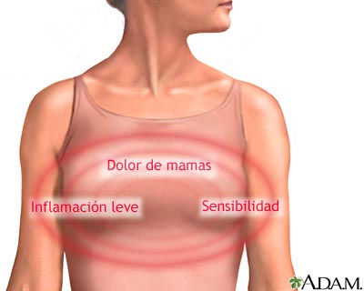 Dolor de mama Dolor de mama
