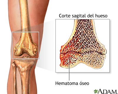 Hematoma óseo Hematoma óseo