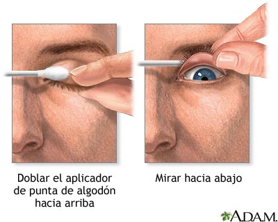 Eversión del párpado Eversión del párpado