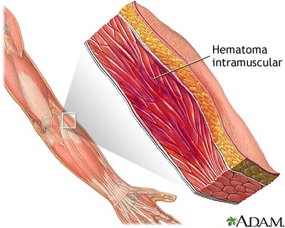 Hematoma muscular Hematoma muscular