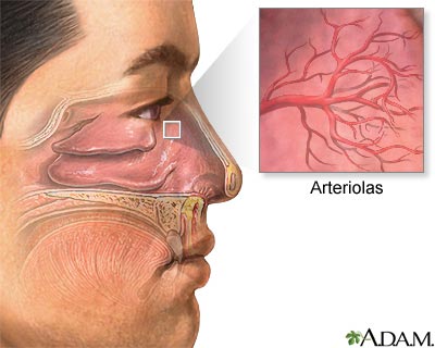 Hemorragia nasal Hemorragia nasal