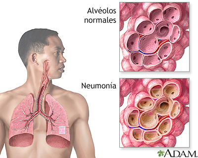 Neumonía Neumonía