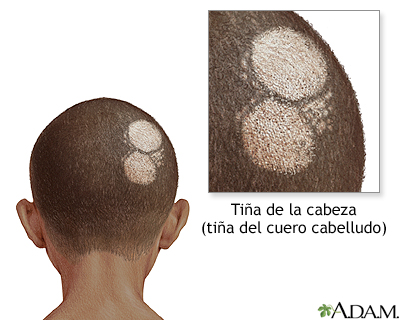 Tiña del cuero cabelludo Tiña del cuero cabelludo