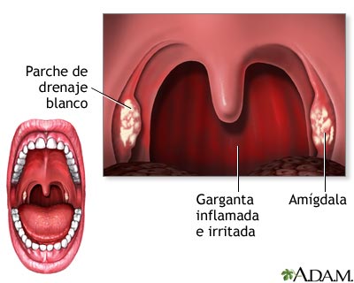 Faringitis estreptocócica Faringitis estreptocócica
