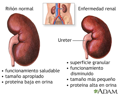 Nefropatía diabética Nefropatía diabética