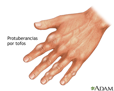 Tofos gotosos en la mano Tofos gotosos en la mano