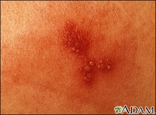Primer plano de herpes simple Primer plano de herpes simple