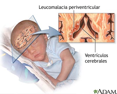 Leucomalacia periventricular Leucomalacia periventricular