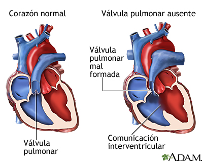 Válvula pulmonar ausente Válvula pulmonar ausente