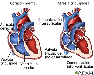 Atresia tricuspídea Atresia tricuspídea