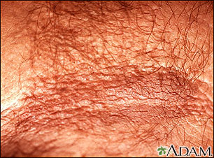 Primer plano de la acantosis pigmentaria Primer plano de la acantosis pigmentaria